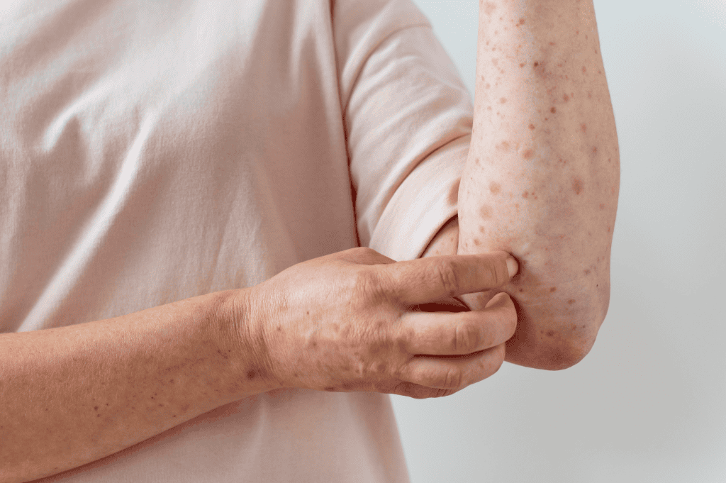 Squamous Cell Carcinoma