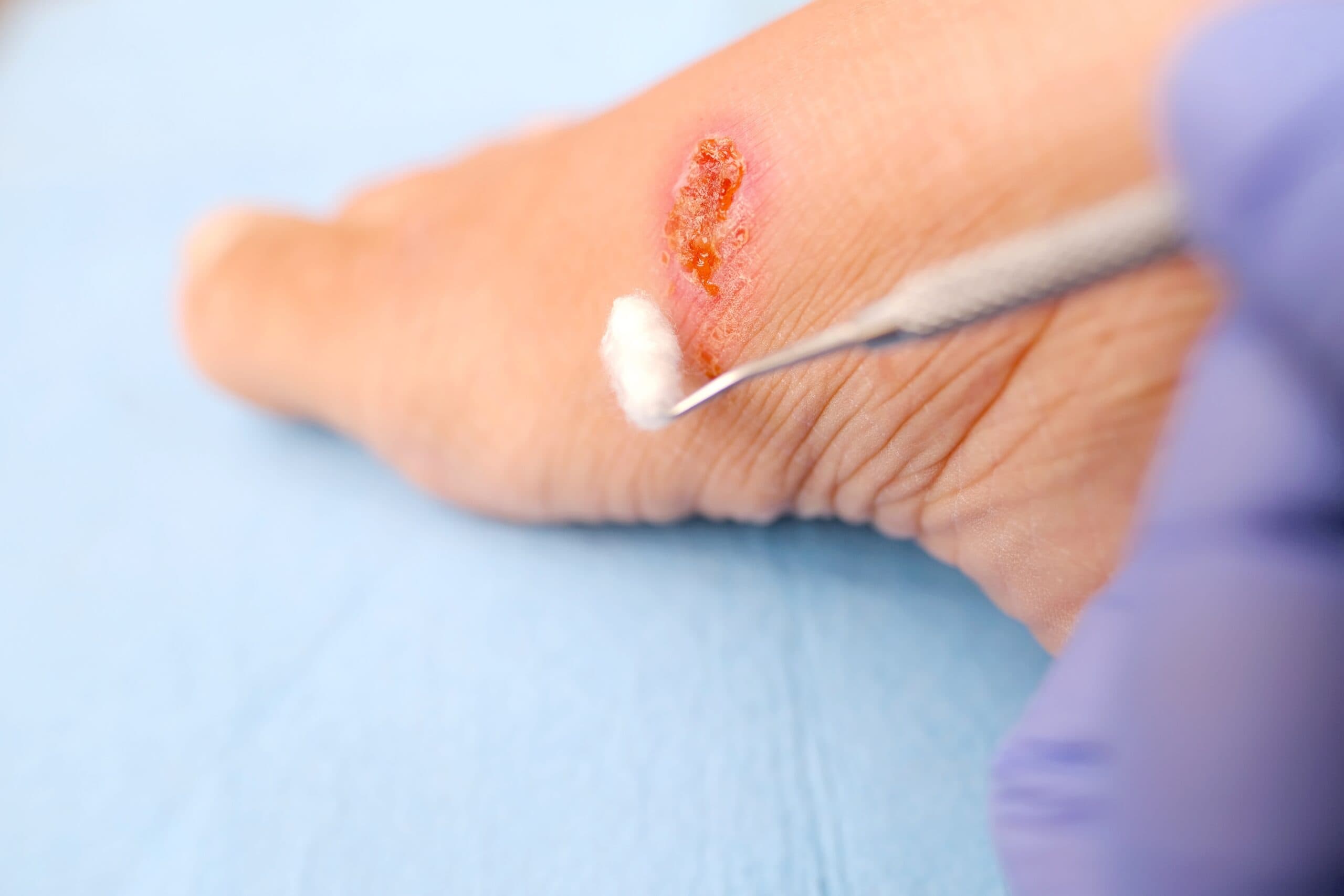 inflamed wound
