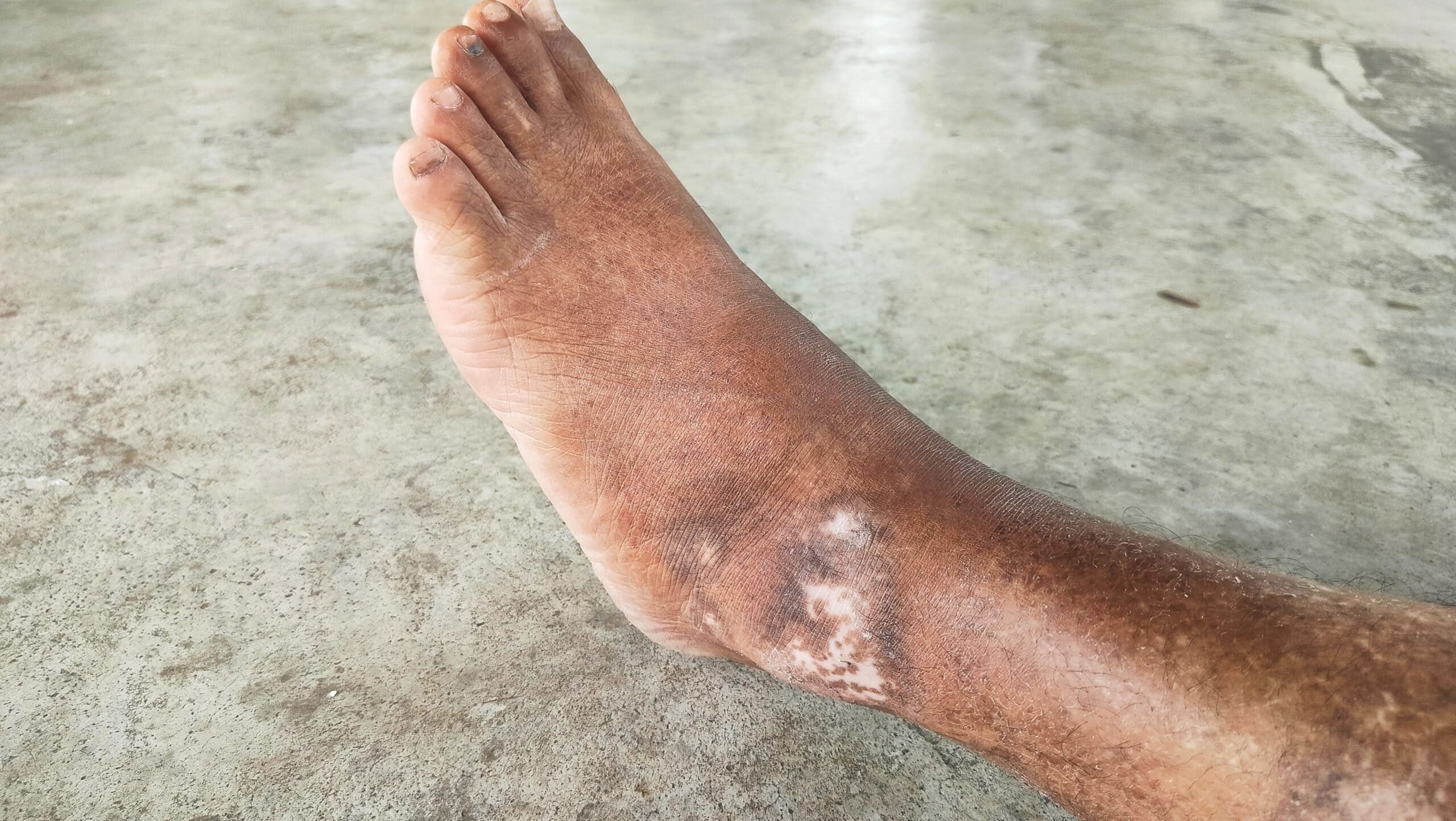 Circulation Related Ulcer